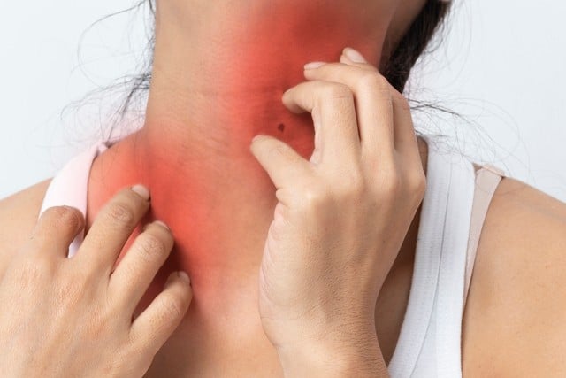 Stock photograph of a model: a woman scratching her reddened neck and shoulder