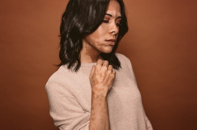 Stock photograph of a model: a dark-haired woman in a beige sweater against a brown backdrop, with lighter patches of skin on her face and hand