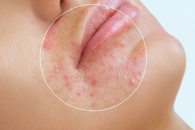 Stock photograph of a model: close-up of a chin and lips with a circle highlighting small red blemishes