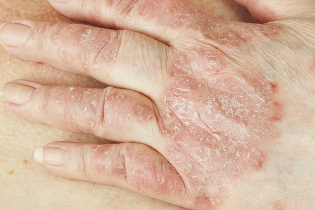 Stock photograph: close-up of a hand with red, scaly, flaking patches of skin across the knuckles
