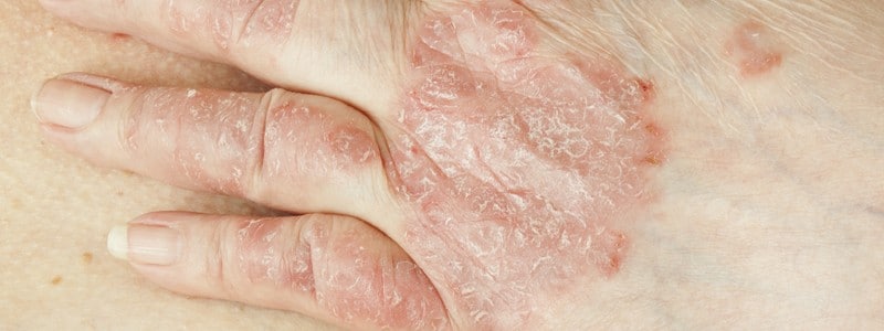 Stock photograph: close-up of a hand with red, scaly, flaking patches of skin across the knuckles