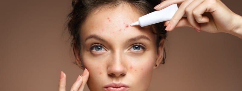 Stock photograph of a model: a woman with blemishes on her face holding a small tube of cream to her forehead