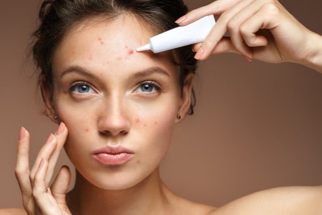 Stock photograph of a model: a woman with blemishes on her face holding a small tube of cream to her forehead