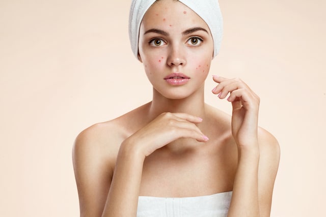 Stock photograph of a model: a young woman with a white towel on her head and red blemishes on her face, looking worried