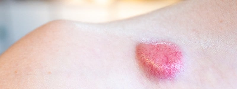 Stock photograph: close-up of a raised, pink-red spot on pale skin of a shoulder