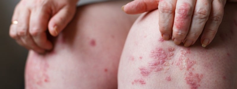 Stock photograph: close-up of a pair of knees with red, scaly patches of skin, one hand resting on a knee