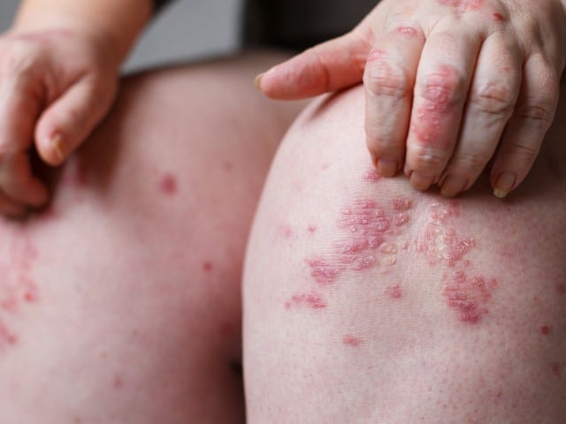 Stock photograph: close-up of a pair of knees with red, scaly patches of skin, one hand resting on a knee