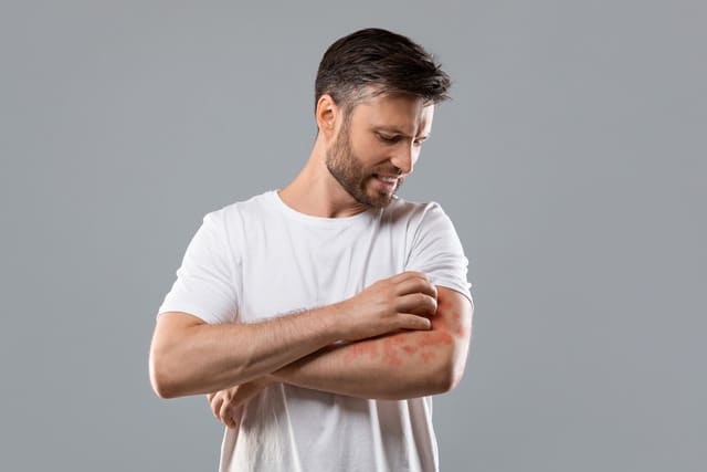 psoriasis 