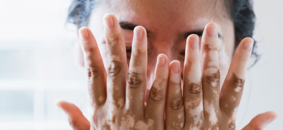 Stock photograph of a model: a person covering their face with both hands, which show lighter patches of skin