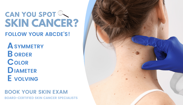 Graphic: Can You Spot Skin Cancer? Follow your ABCDEs: asymmetry, border, color, diameter, evolving; book your skin exam