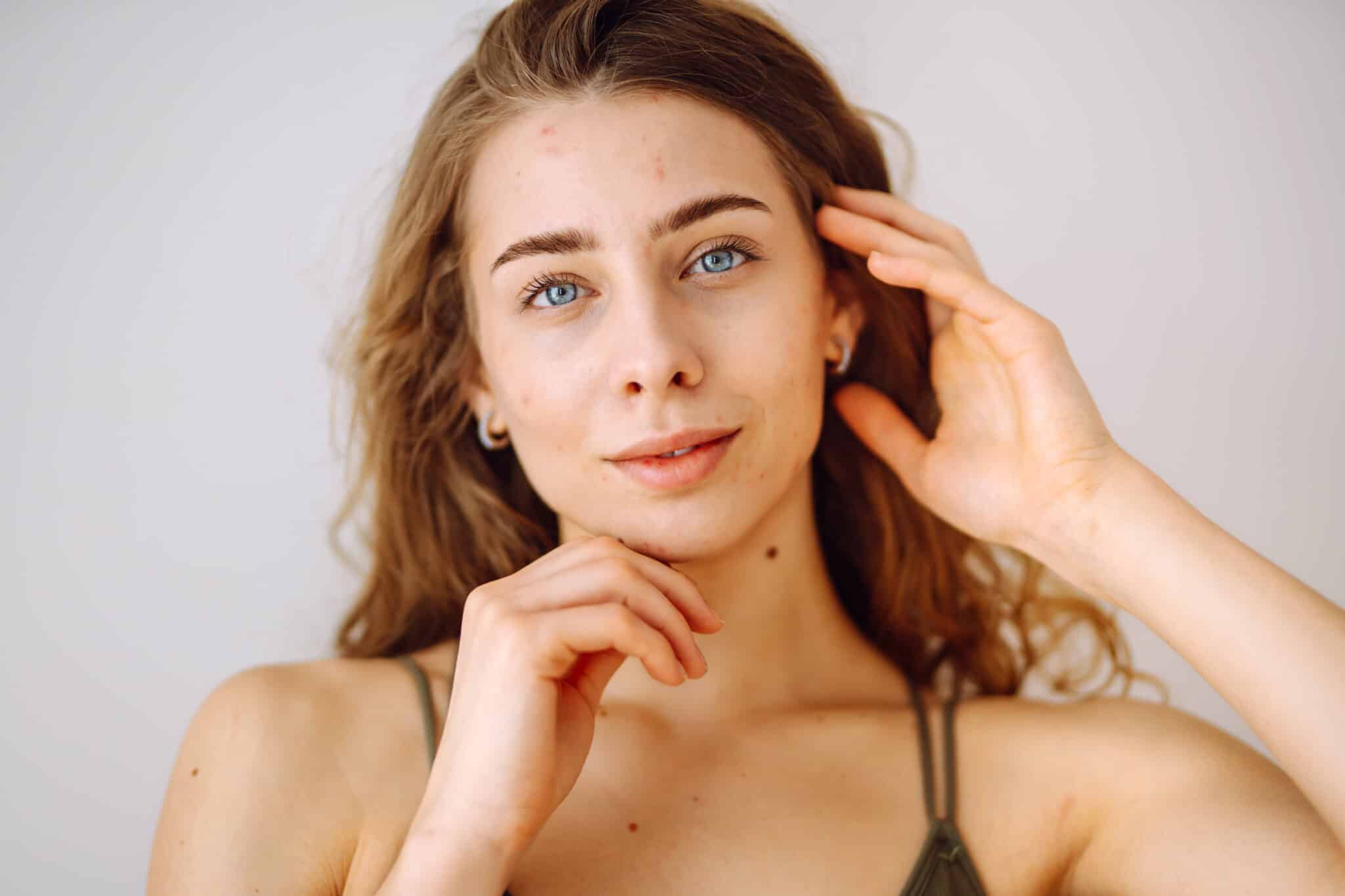 Beautiful young girl with problem skin. Young woman with wavy hair gently touching her face.Dermatology, cosmetology, skin care. Natural skin.