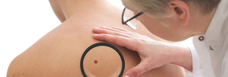 Stock photograph of models: a clinician examining a mole on a person's back, with a magnifying lens over the spot