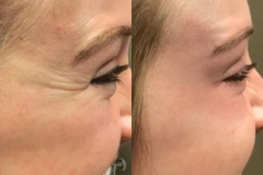 botox1