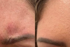 botox2
