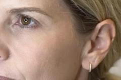 Chemical-Peel-After