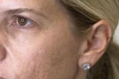 Chemical-Peel-Before