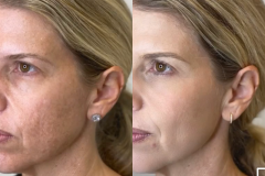 chemical_peels1
