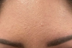 Botox-11-After