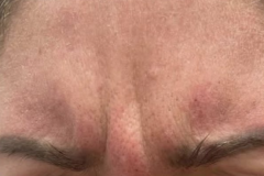 Botox-11-before