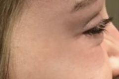 Botox-Crows-Feet-After