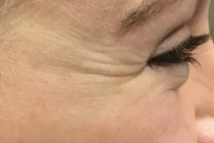 Botox-Crows-Feet-Before