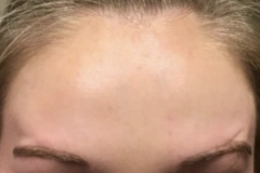 Botox-Female-Forehead-After