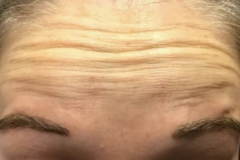 Botox-Female-Forehead-Before
