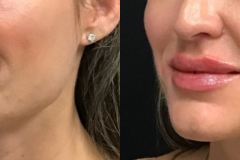 fillers1