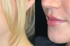 fillers2