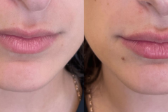 fillers3