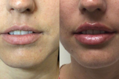 fillers5