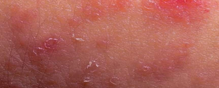 Close up picture of skin with eczema - Eczema Treatment in Coral Gables FL