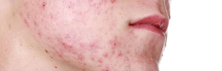 causes of acne and best acne treatment options