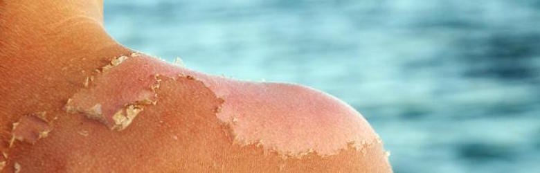 how to treat a sunburn