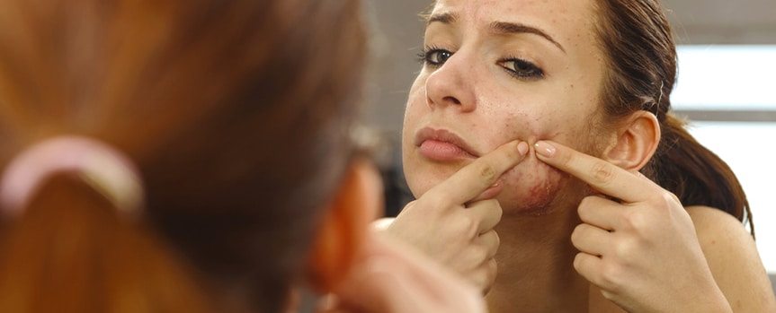 woman with acne looking herself on the mirrow