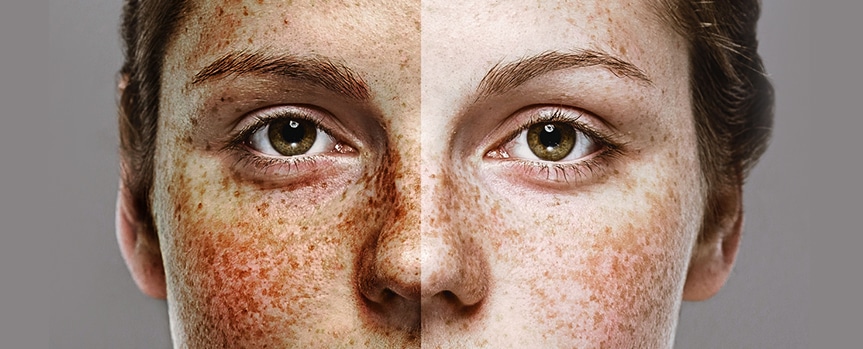 healthy skin vs sun damaged skin comparison