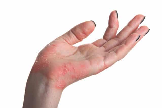 psoriasis hand