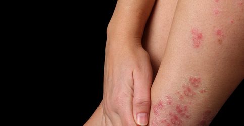 Psoriasis Treatment Coral Gables, FL