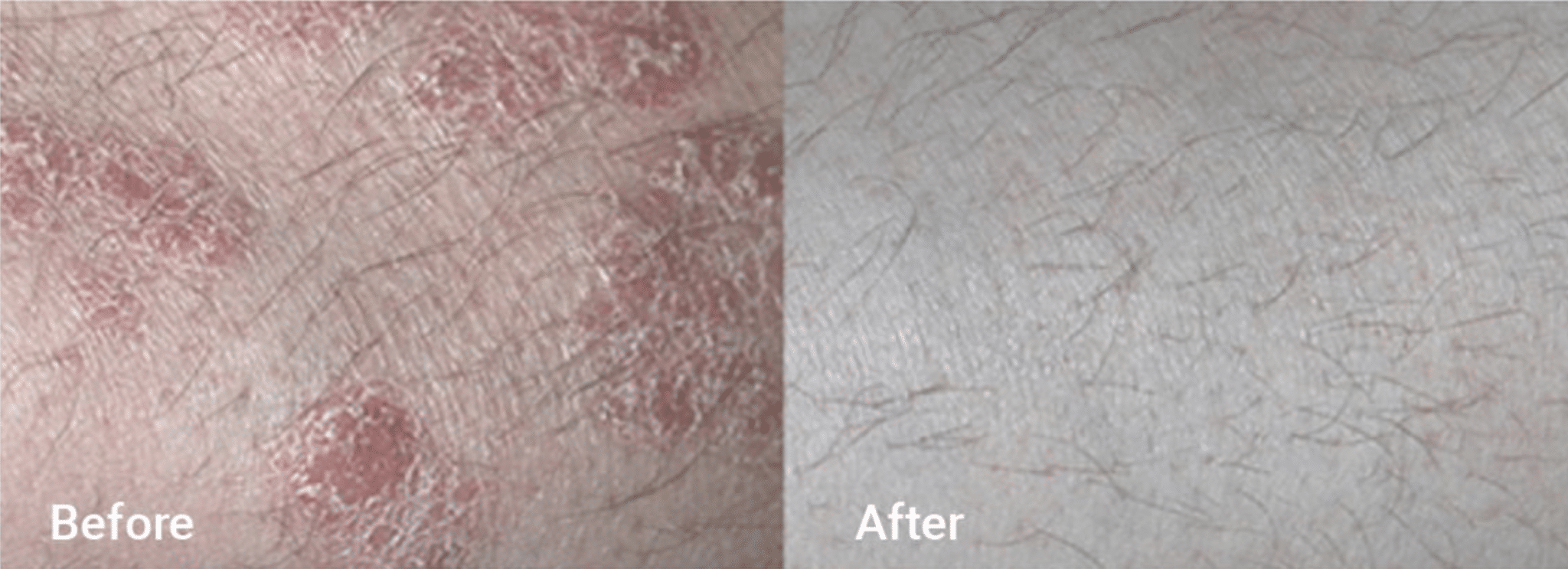 before & after image of psoriasis treatment
