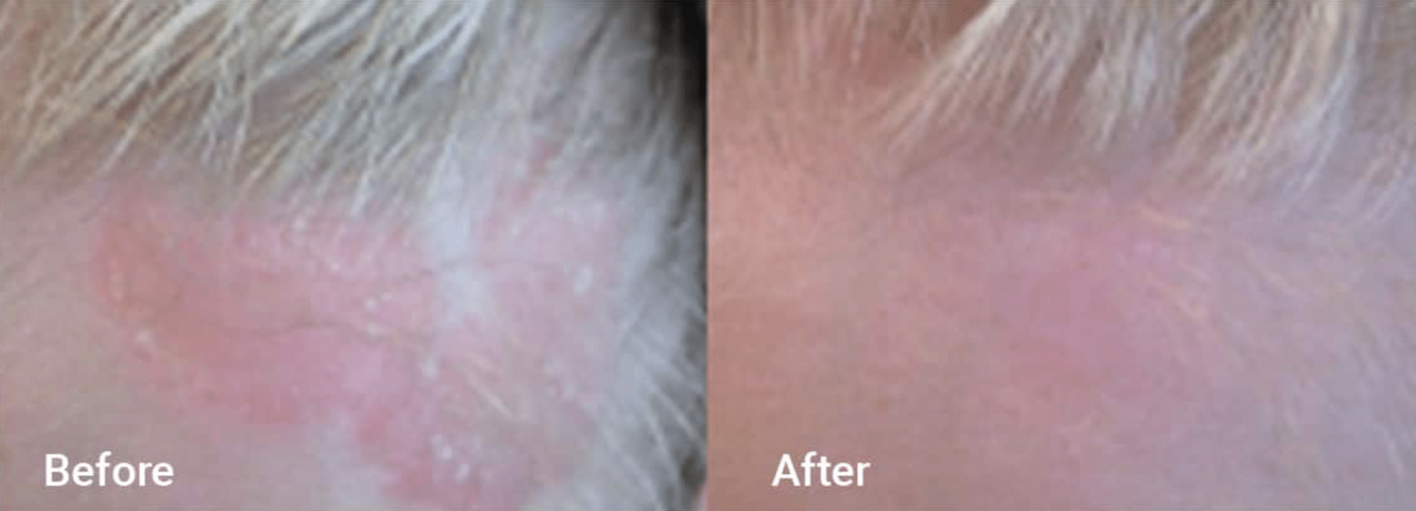 before & after image of psoriasis treatment on the forehead