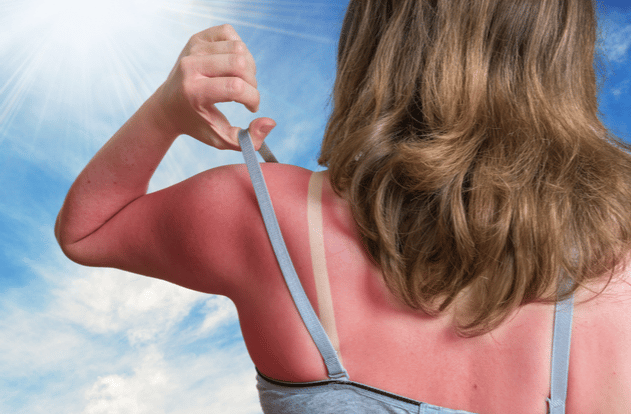 woman with red sunburned skin on her back.