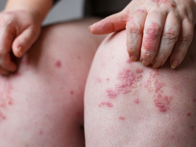 women itching and scratching psoriasis spots by hand