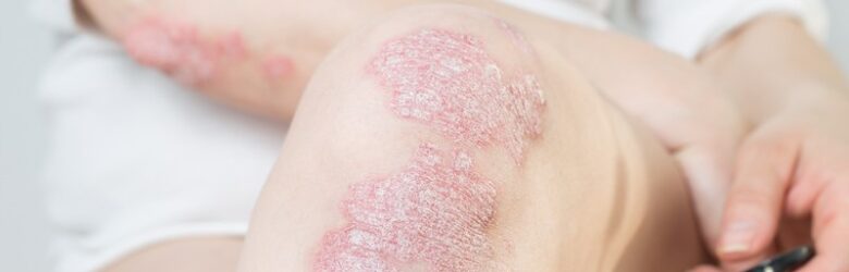 Acute psoriasis on the knees ,body ,elbows